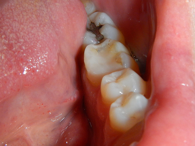 Repaired Tooth and Replaced Composite Filling