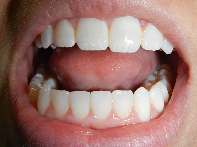 Repaired Tooth with Composite Bonding